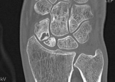 Scaphoid Proximal Pole Non Union